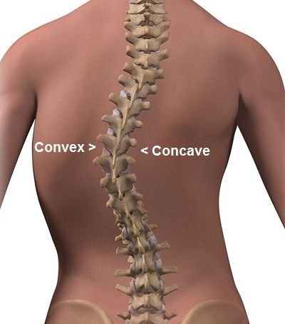 Scoliosis Img